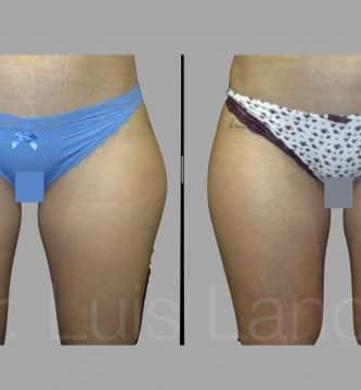 Liposucción cartucheras.
