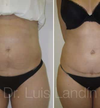 Abdominosplastia.