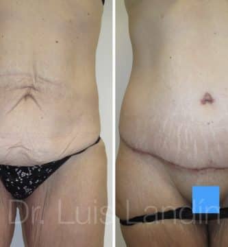 Abdominoplastia tras perder peso.