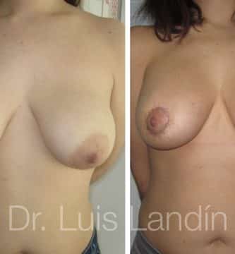 Mastopexia periareolas con implantes anatómicos 330cc.