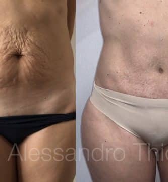 Abdominoplastia tras embarazo